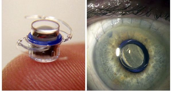 Telescopic Eye Implant Approved By The FDA