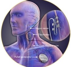 F*ck Outta Here: VNS Implant Might Fix The Ringing In Your Ears